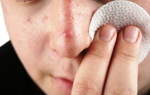 How to Remove Blackheads quickly